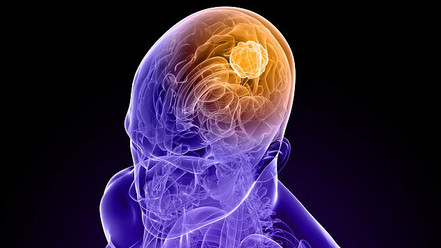 高悪性度神経膠腫の市場規模、分析、業界統計、最新の洞察(2033年まで)