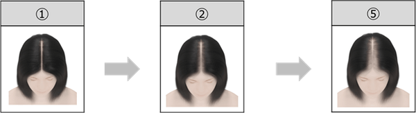 例　頭皮ケアの透け感