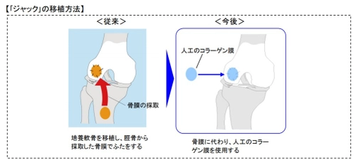 患者の身体的負担の軽減と医師の移植手技の簡便化を実現　 再生医療製品「自家培養軟骨ジャック(R)」の一部変更承認を取得 