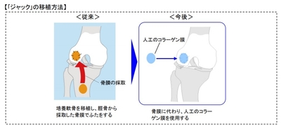 「自家培養軟骨ジャック(R)」の一部変更承認を取得 