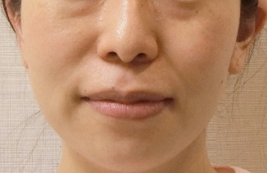 年齢とともに気になる「顔の左右非対称」