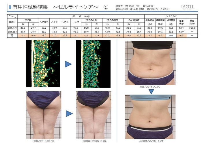 レセル ボディによる有用性試験結果(セルライトケア)の一例