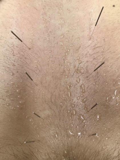 腰部に鍼をしているところ(しばらくすると代謝がUP) 腰部生殖機能の反応点があり、玉のような汗がでています(笑)