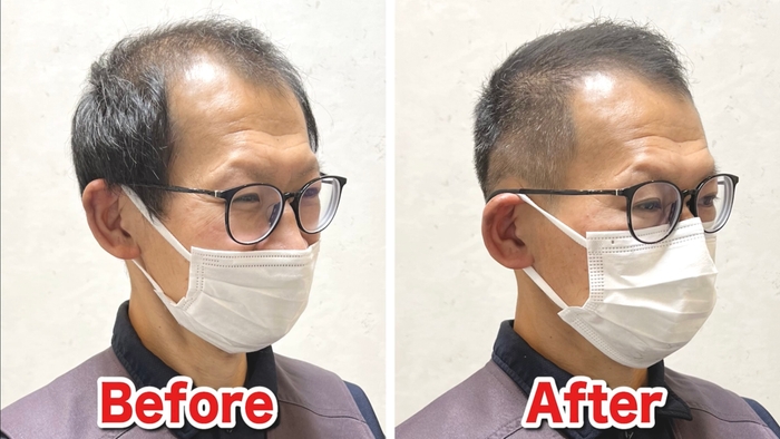 U字薄毛をカットで改善(2)