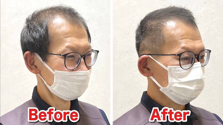 U字薄毛をカットで改善(2)