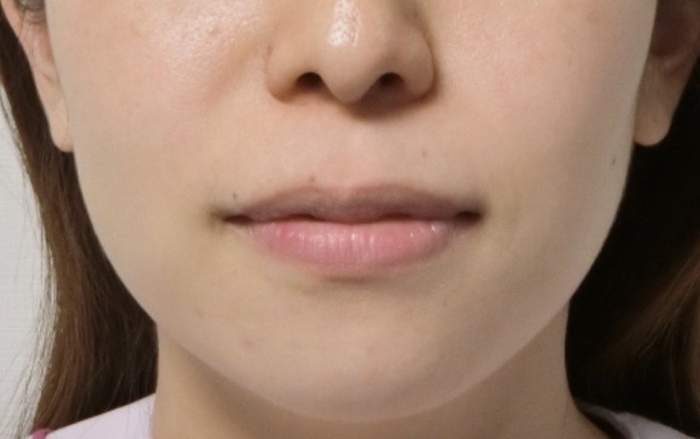 矯正治療後。左右のアンバランスが改善されている。